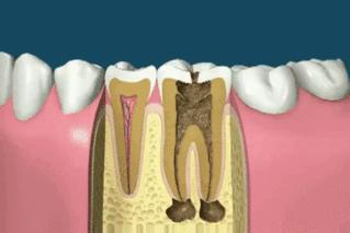 Root Canal Treatment In 1 Visit only at www.topdentistdelhi.com